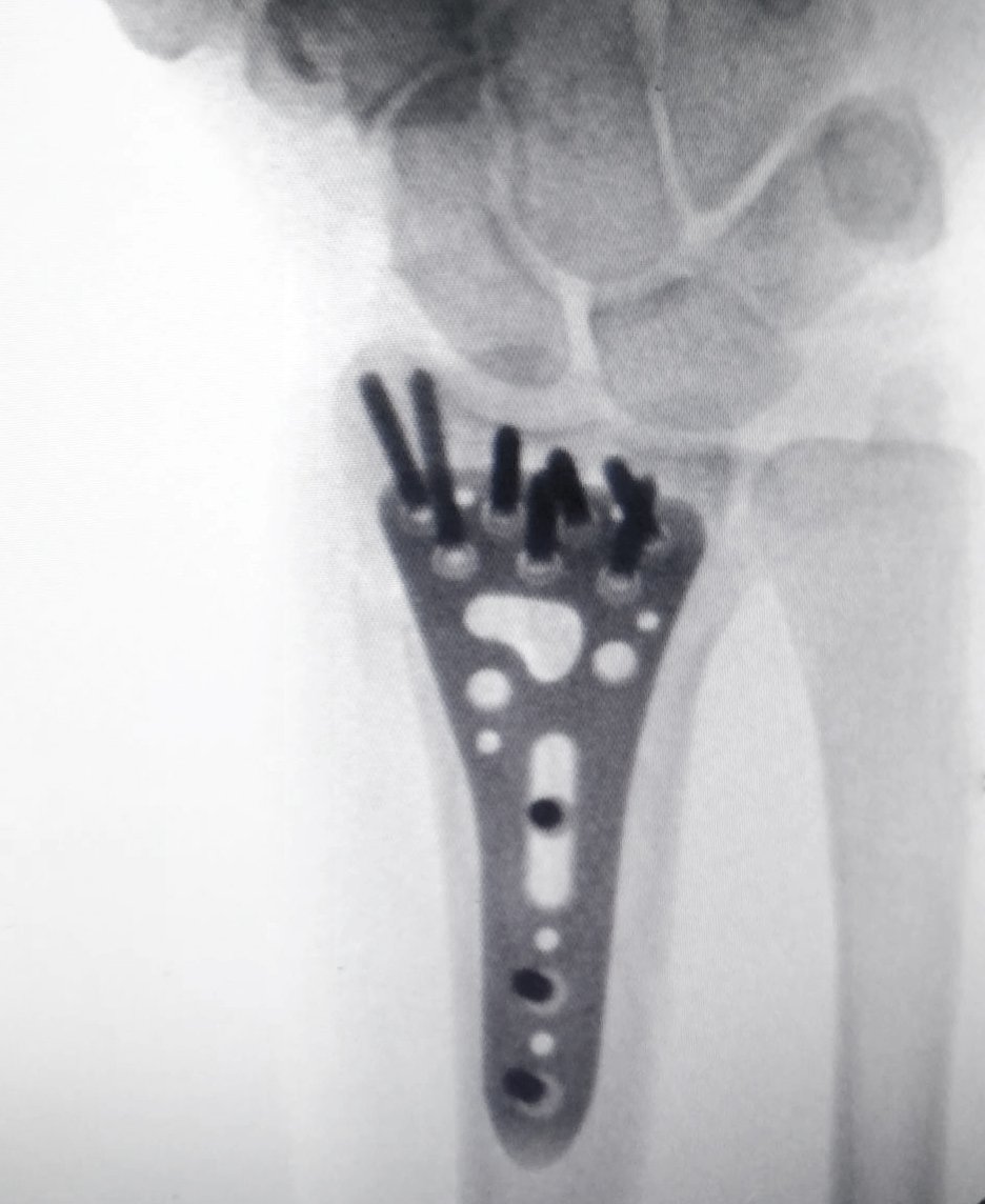 Hofer titanium plate distal radius fracture fixation X-ray